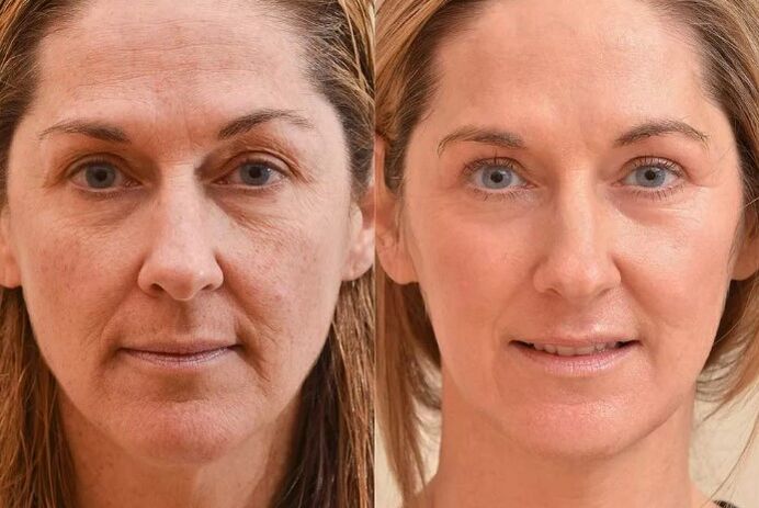 The rejuvenation of the face before and after