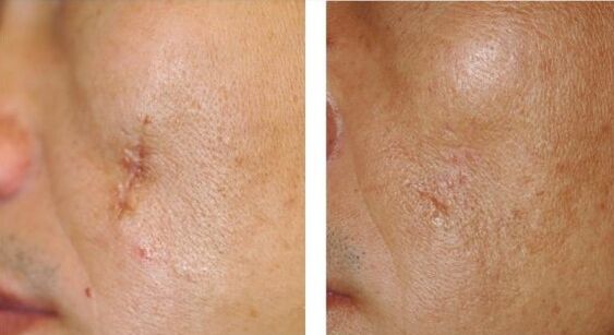 Laser's result
