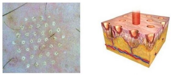 The fraction affects the laser skinpoint