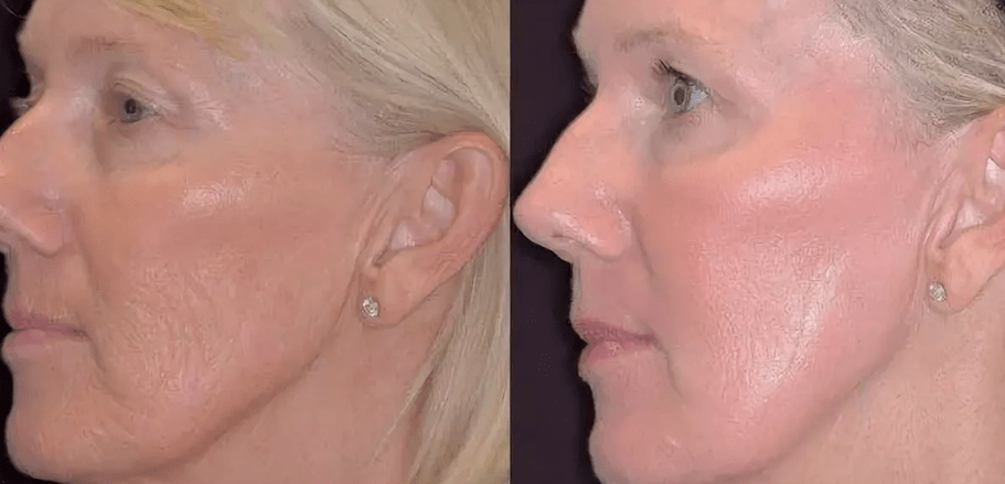 Before and after laser photorage