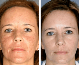The effects of the procedure