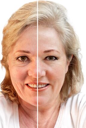 The rejuvenation of the face