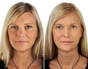 before and after