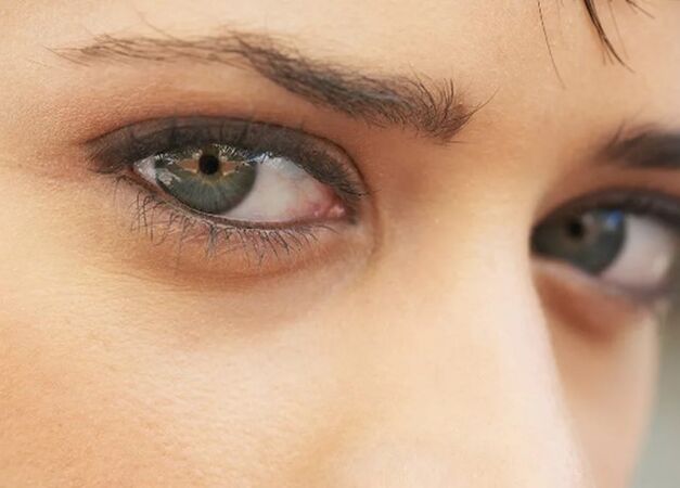 Dark circles beneath the eyes