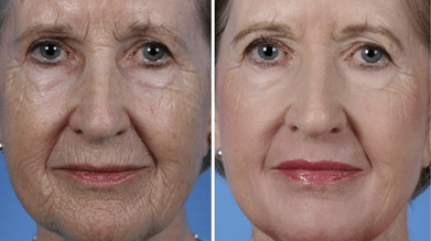 fractional rejuvenation of facial skin before and after photos