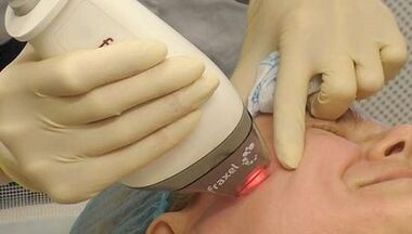 How fractional skin rejuvenation is performed