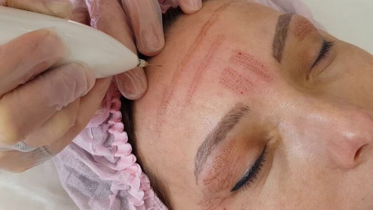 Plasma rejuvenation of the face