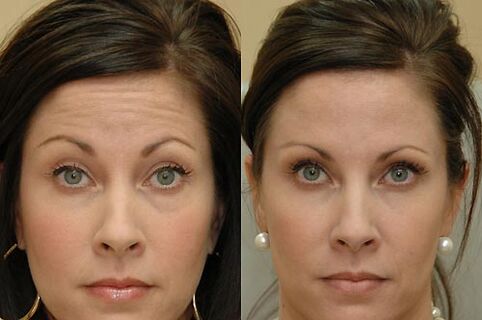Botulinum toxin injections are suitable for use on any area of ​​the face