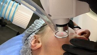 laser rejuvenation of facial skin