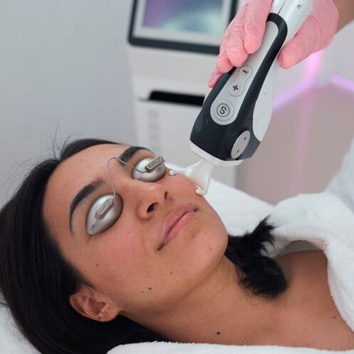 Fractional laser skin treatment