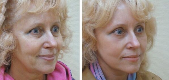 Before and after plasma rejuvenation of female facial skin