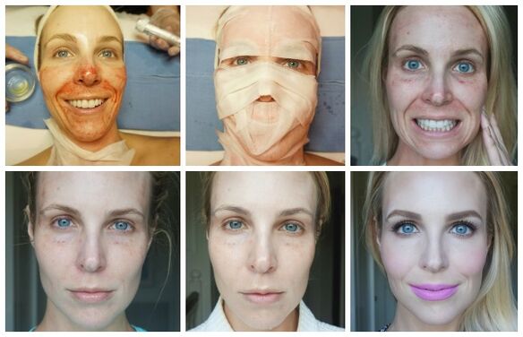 Stages of facial skin recovery after successful plasma lifting